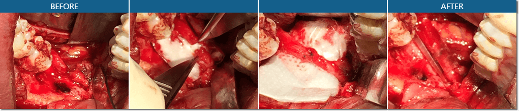 Trigeminal Nerve Repair Before And After