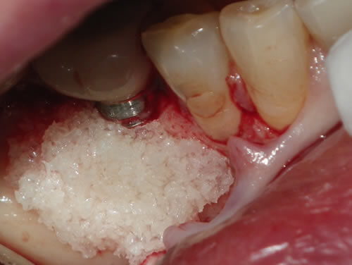 Dental Implant Complication After