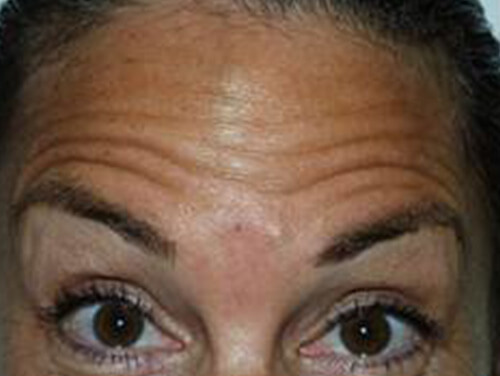 Botox® Cosmetic Treatment Before