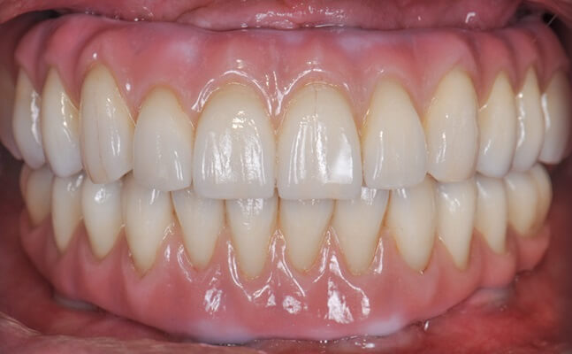 Bone Lost And Unstable Denture Treatment After