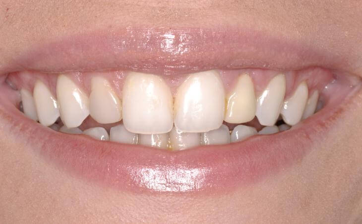 Immediate Dental Implant Surgery After