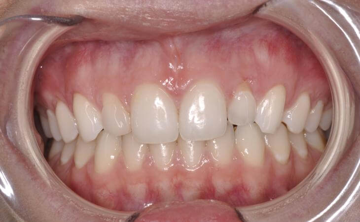Immediate Dental Implant Surgery Before