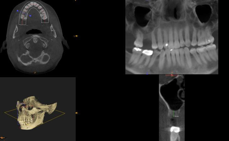 Internal Sinus Lift And Implant Placement Before