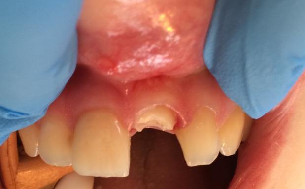 Immediate Dental Implant For Broken Tooth Before