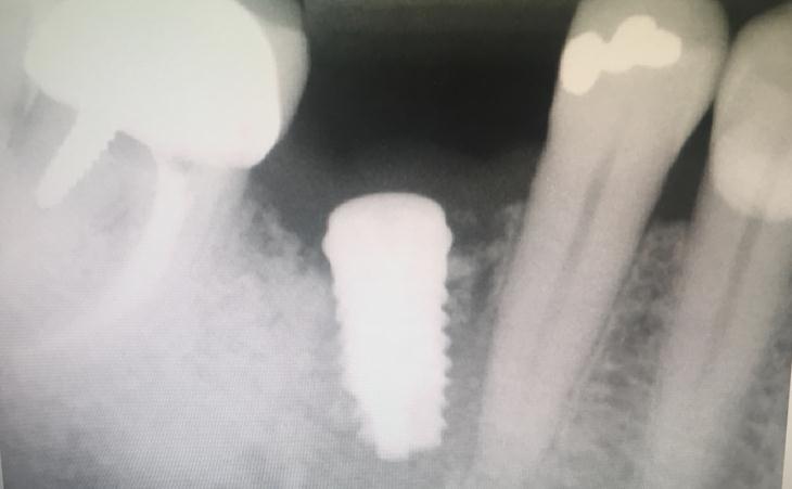 Replacing A Failed Implant Placed By A General Dentist Before