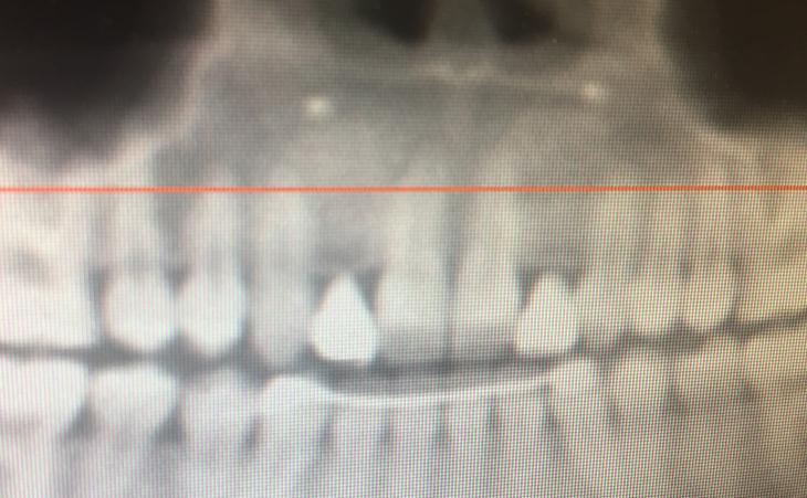 Replacing Missing Lateral Teeth Since Birth Before