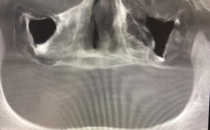 Before Bilateral Sinus Lifts