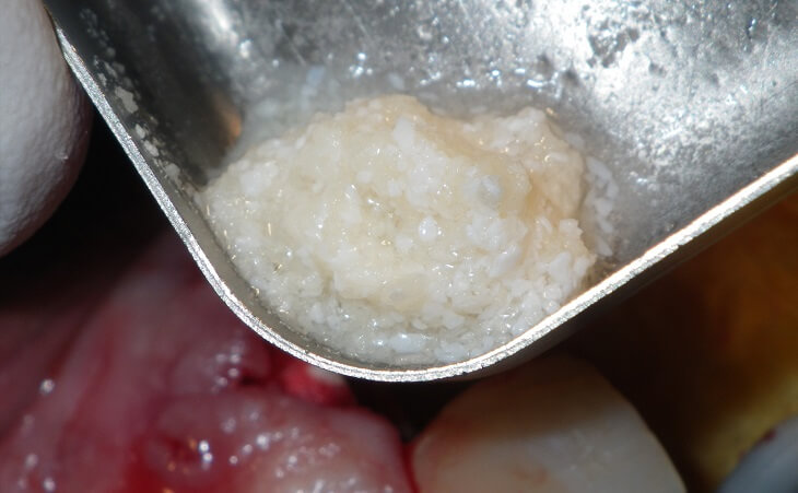 Bone Graft For Single Tooth Replacement