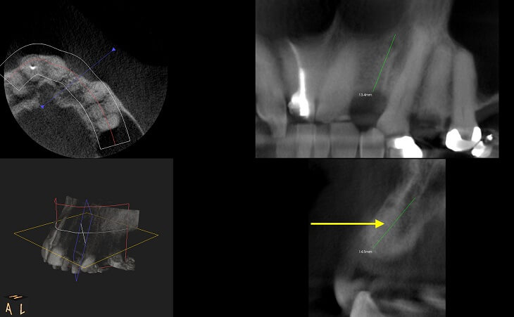 CT Scan Of Bone Graft Results