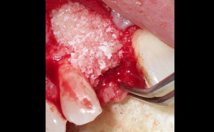 Bone Graft For Single Tooth Replacement