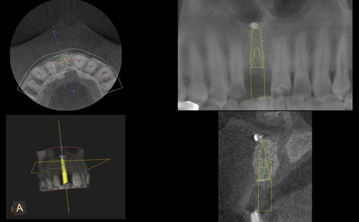 Single Dental Implant X-Ray