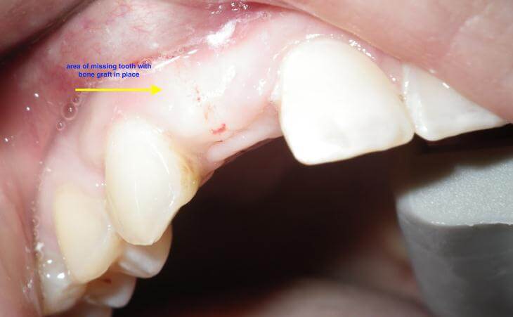 Missing Tooth Treatment After Bone Graft