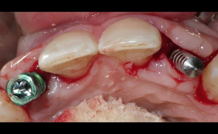 Dental Implants After Bone Grafting