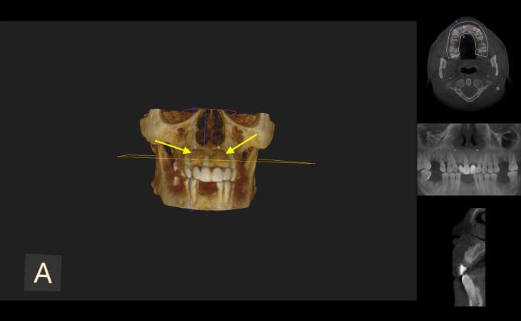 Dental Bone Graft Results