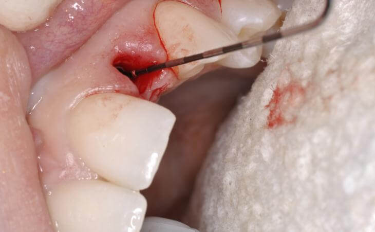 Dental Implant Bone Check