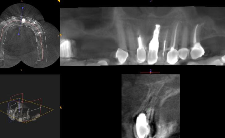Bilateral Sinus Lift Surgery CAT Scan