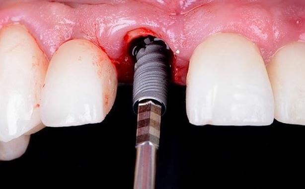 Dental Implant Placement
