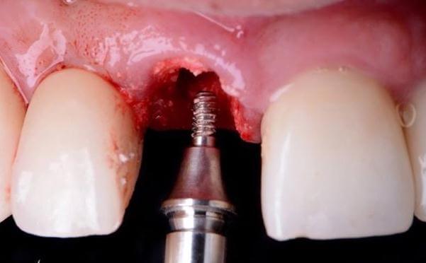 Attaching Abutment To Dental Implant