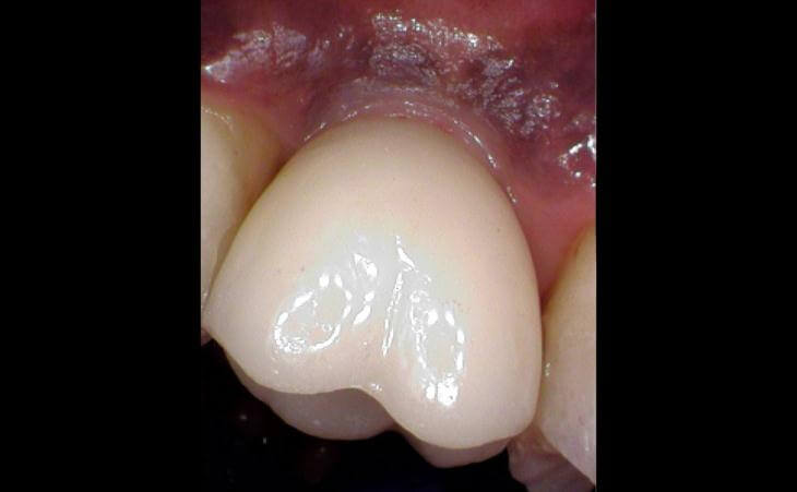 Restored Tooth From Dental Implants