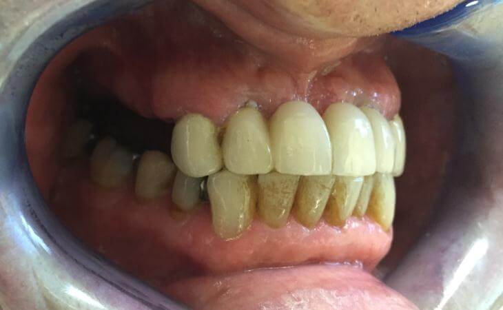 Before Decayed Tooth Removal