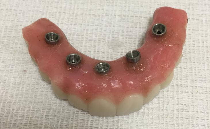 New Teeth For Tooth Replacement