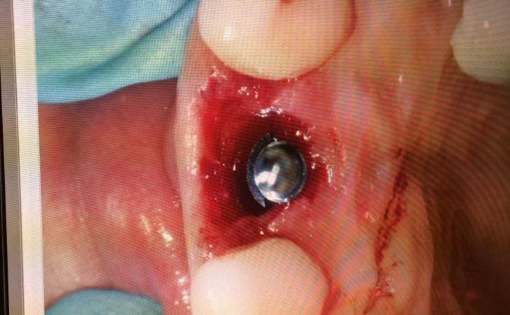 Tooth Extraction And Dental Implant Placement