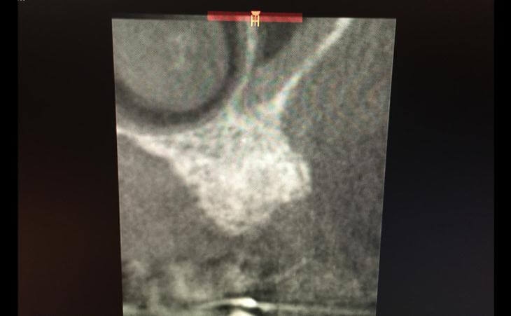 Guided Implant Placement X-Ray