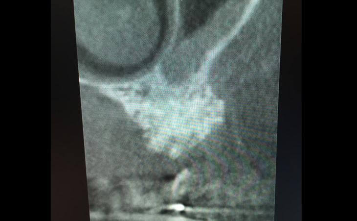 Guided Implant Placement X-Ray Scan
