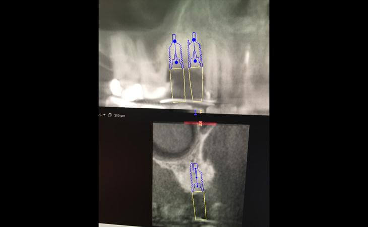 X-Ray For Guided Implant Placement 