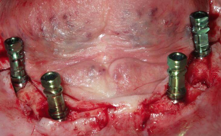 Multiple Dental Implant Placements