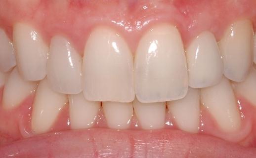 Multiple Dental Implant Results