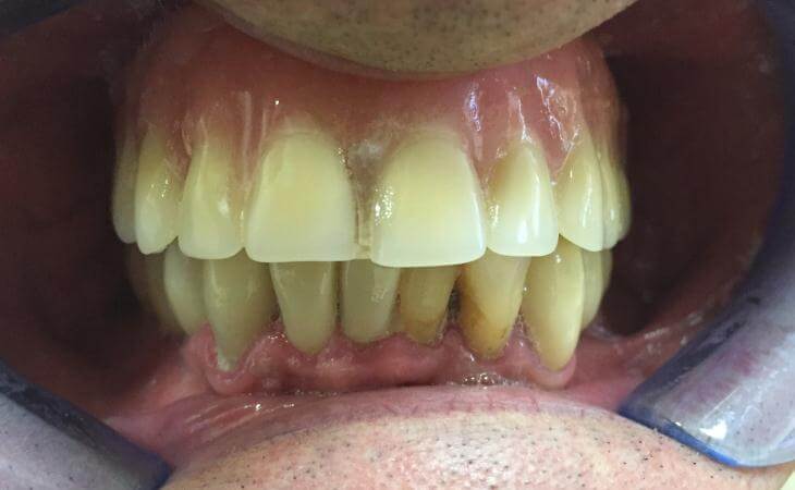 Same Day Dental Implant Surgery Results
