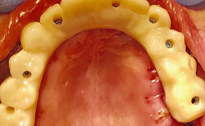 Temporary Upper Teeth Placed At Same Time As Dental Implants