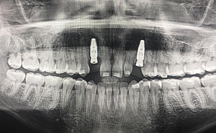 Dental Implants Placed And Baby Teeth Extracted In The Same Surgery