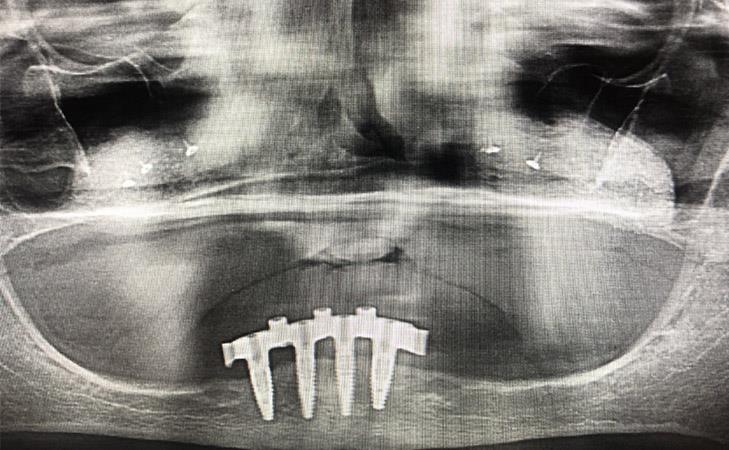 Upper Jaw Bone Resorbtion X-Ray