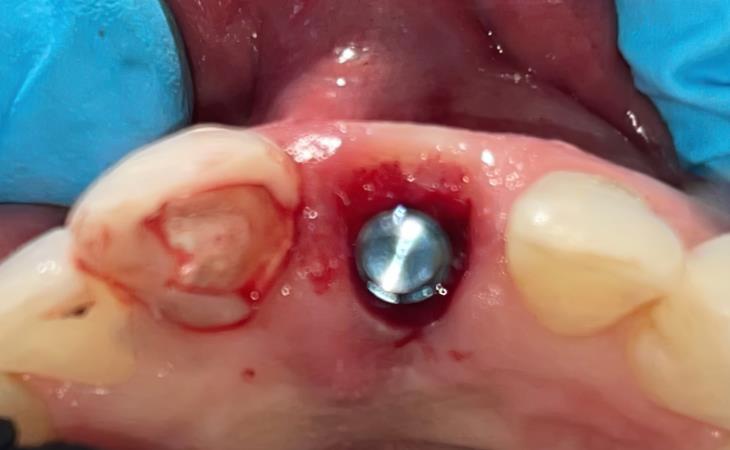 Implant Site for Front Tooth Replacement