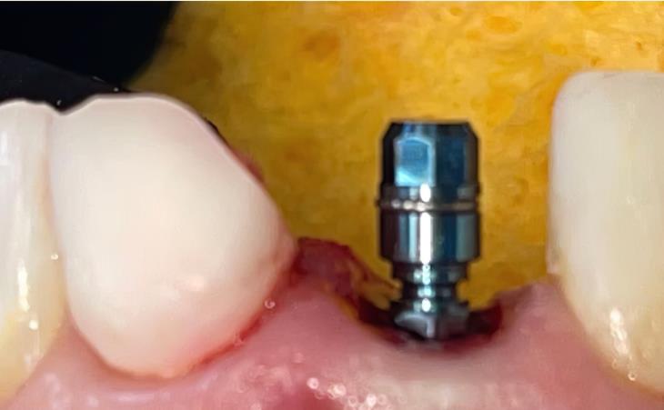 Placement of Dental Implant in Front Tooth
