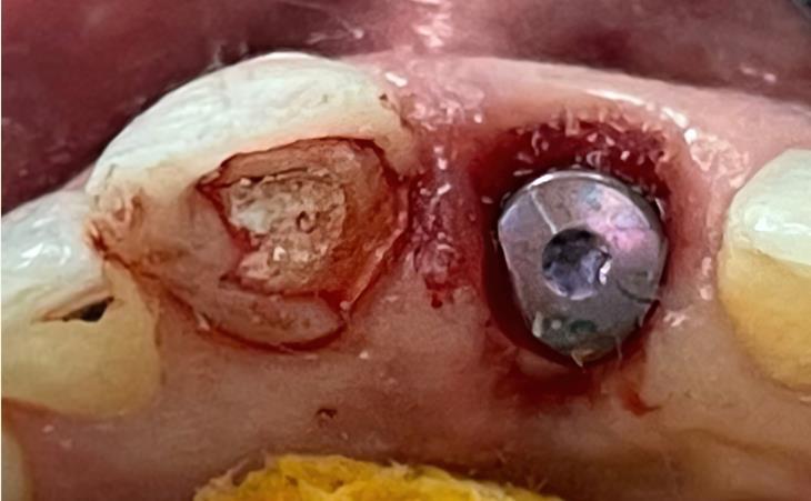 Front Tooth Implant – Above View