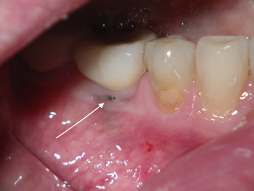 Dental Implant Complication Before