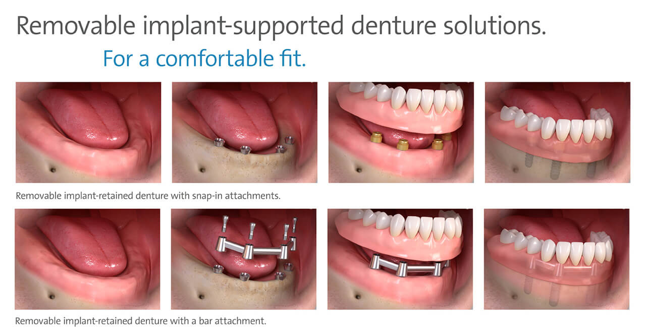 Removable Implant-Supported Denture Solutions