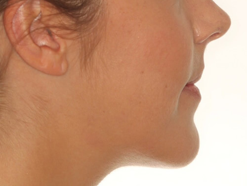 Jaw Surgery After Side View