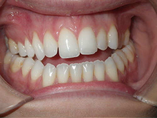Jaw Surgery Before Jaw Surgery Before