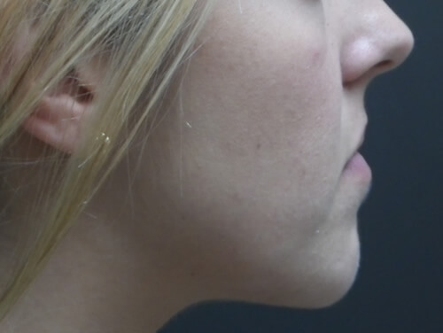 Jaw Surgery Before Side View Jaw Surgery Before Side View