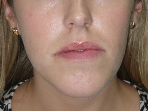 Orthognathic Surgery Before Orthognathic Surgery Before