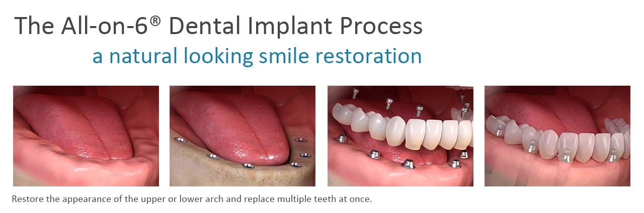 Removable Implant-Supported Denture Solutions