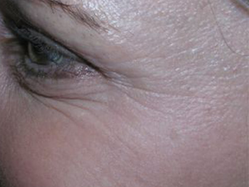 Botox® Cosmetic Injections After
