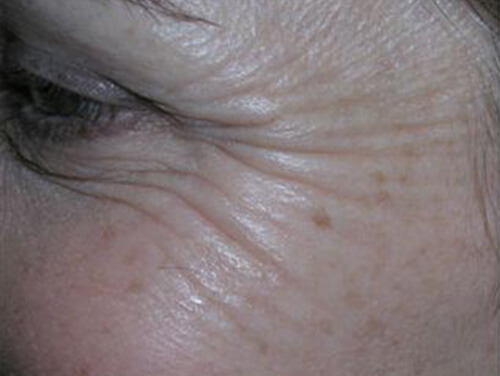 Botox® Cosmetic Injections Before