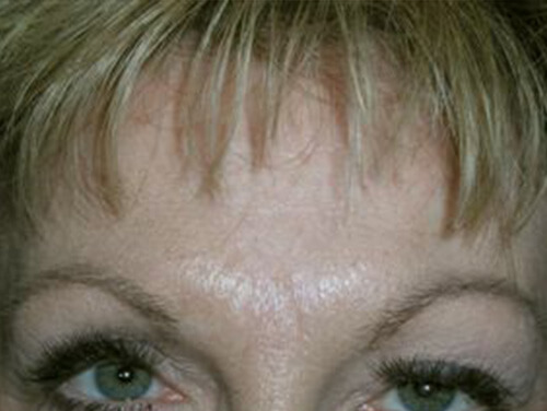 Botox® Injections After