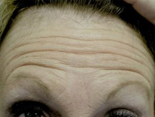 Botox® Injections Before