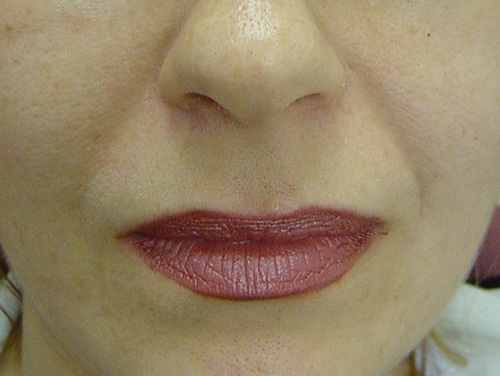 Facial Filler Treatment After Facial Filler Treatment After